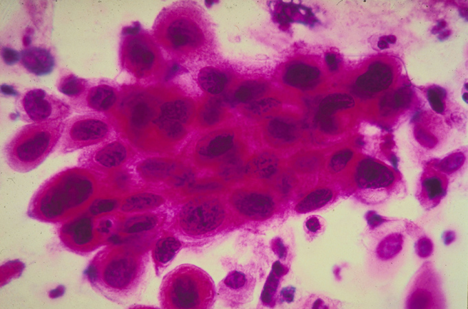 Cervical cancer