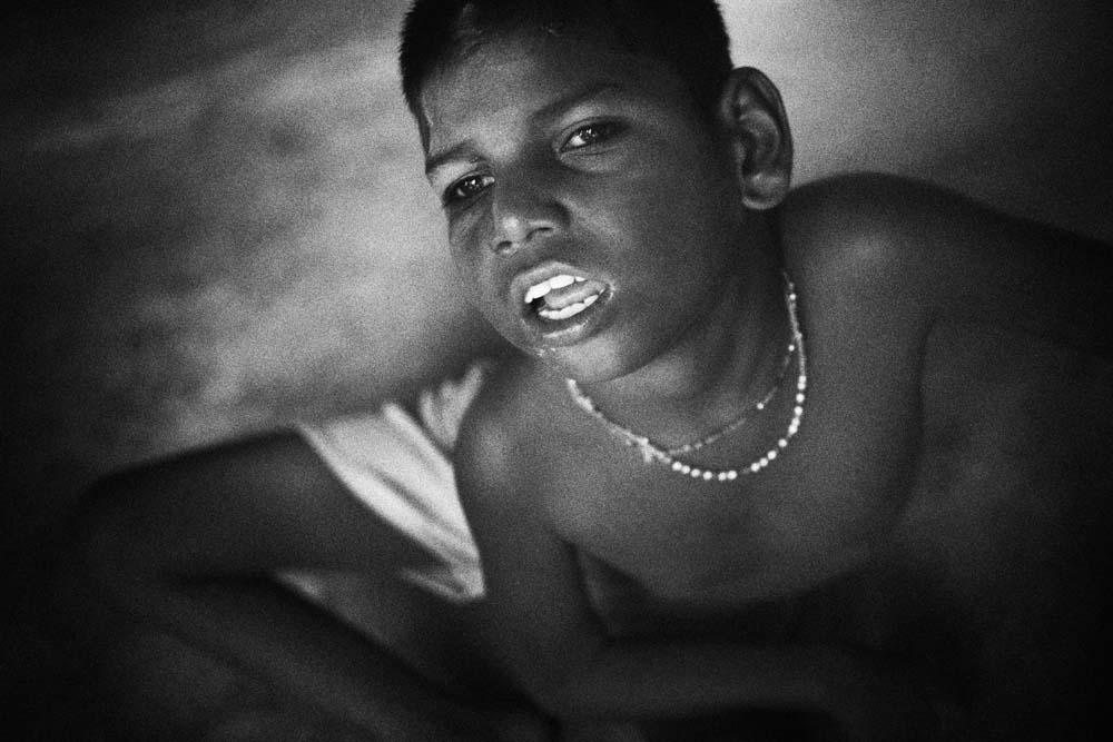 Karan Ishad (5) of Jana village in Jajmau area is a neurological patient with physical and mental deformities since his birth. These kinds of diseases are very common in the villages around Jajmau area. The local media and doctors relate it with chromium contamination. Kanpur, Uttar Pradesh, India.