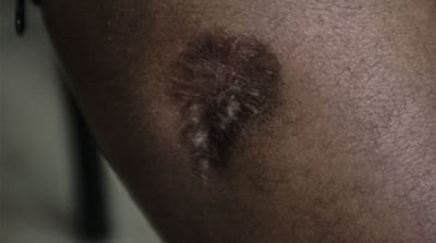 Shiden shows the scars of wounds he sustained after being shot by Egyptian border guards in 2011 [Violeta Moura/Al Jazeera]