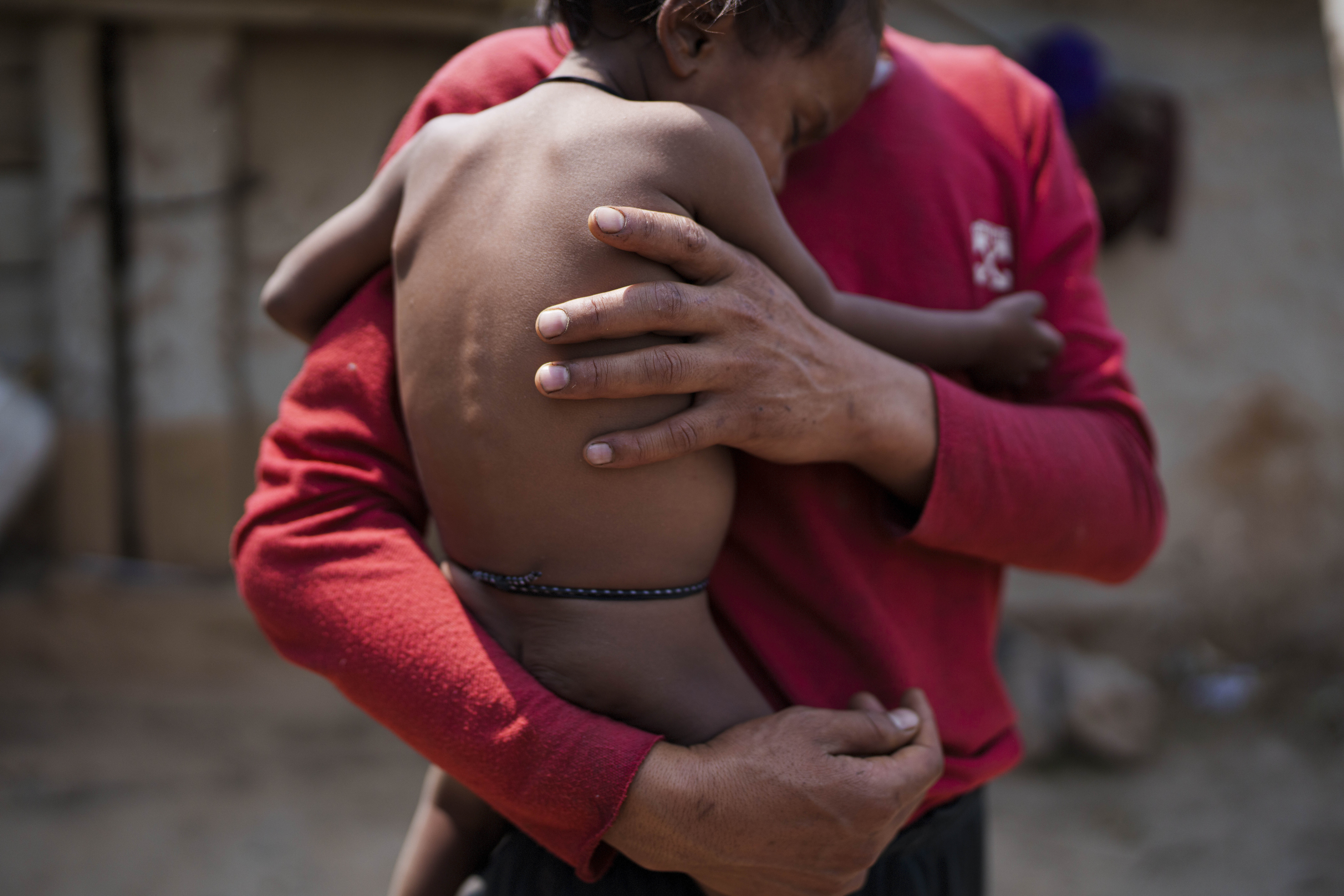 A man carries his malnurished child