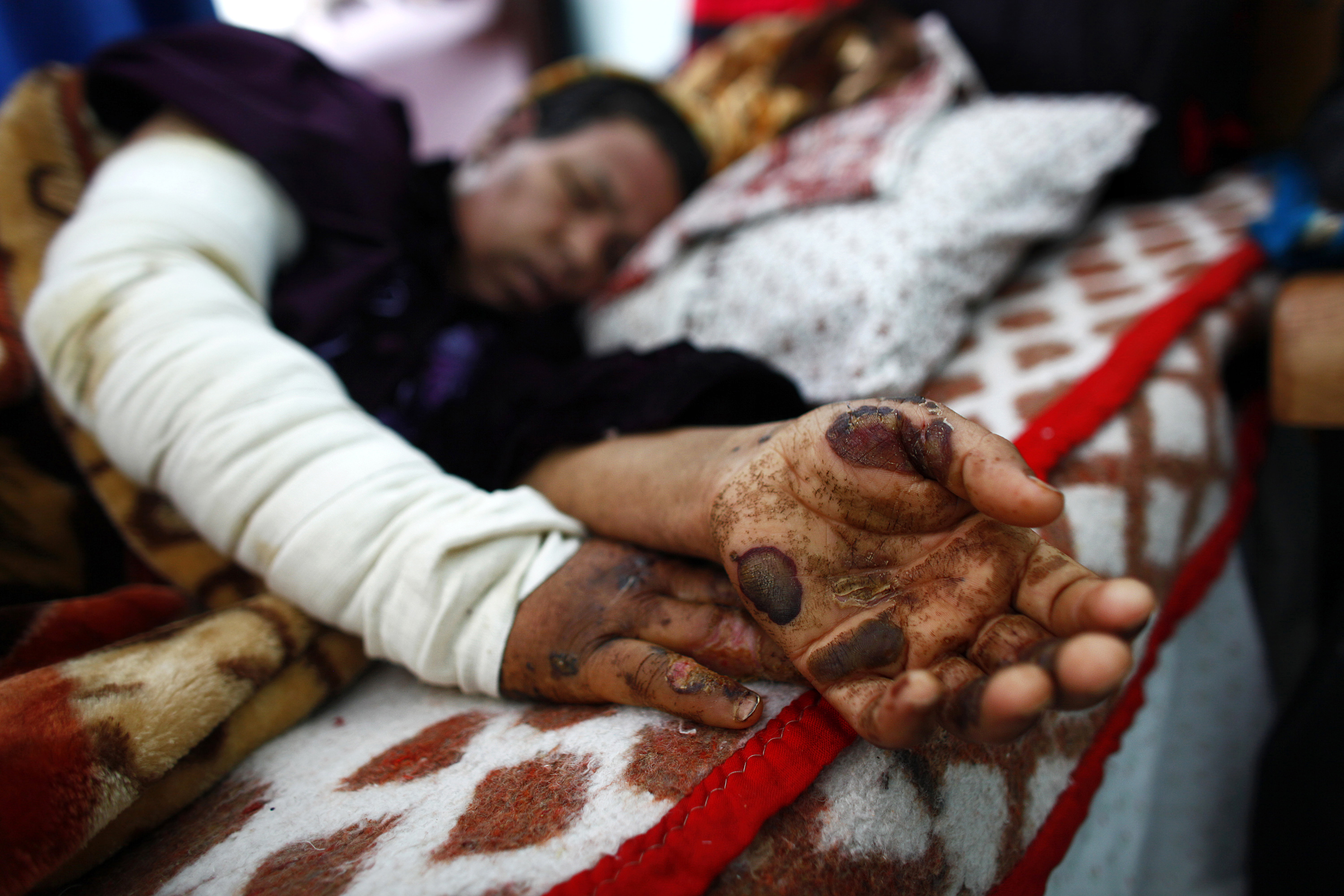 Closeup of woman's hands with burns that have drilled through into her flesh