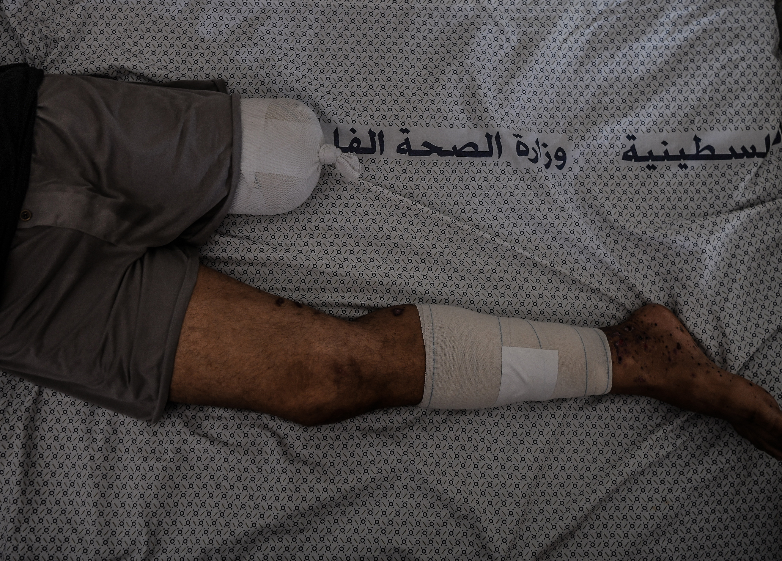 KHAN YUNIS, GAZA - NOVEMBER 13: Palestinians who lost their limbs are receiving medical treatment at Nassr Hospital in Khan Yunis, Gaza on November 13, 2023. Ongoing Israeli attacks left hundreds of Palestinians amputated. (Photo by Abed Zagout/Anadolu via Getty Images)