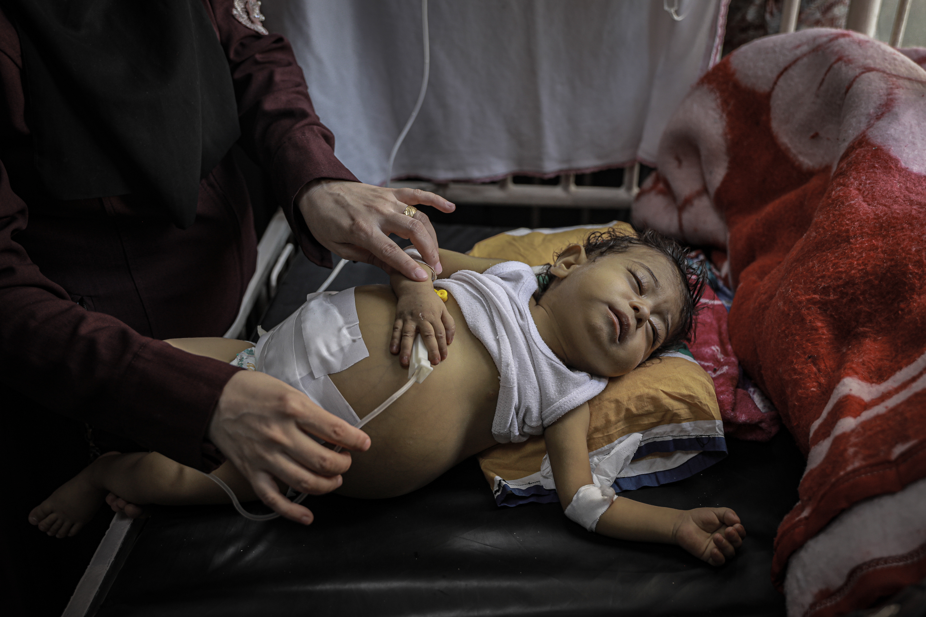 Sadeel, jaundiced, intubated, swollen