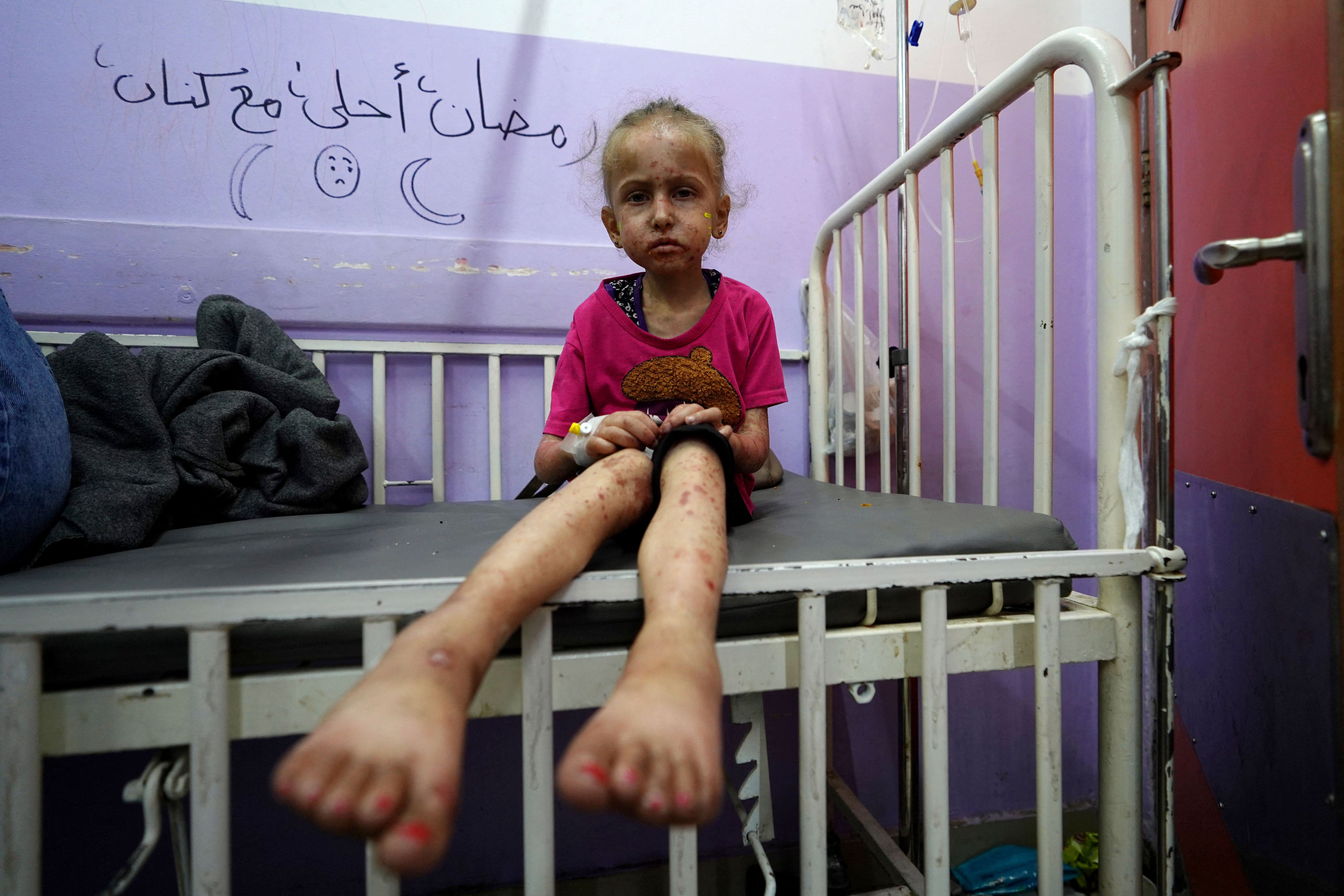 A Palestinian child waits for malnourishment treatment, at Al-Aqsa Martyrs Hospital in Deir al-Balah in the central Gaza Strip on May 30, 2024, amid the ongoing conflict between Israel and the Palestinian Hamas militant group. (Photo by Bashar TALEB / AFP