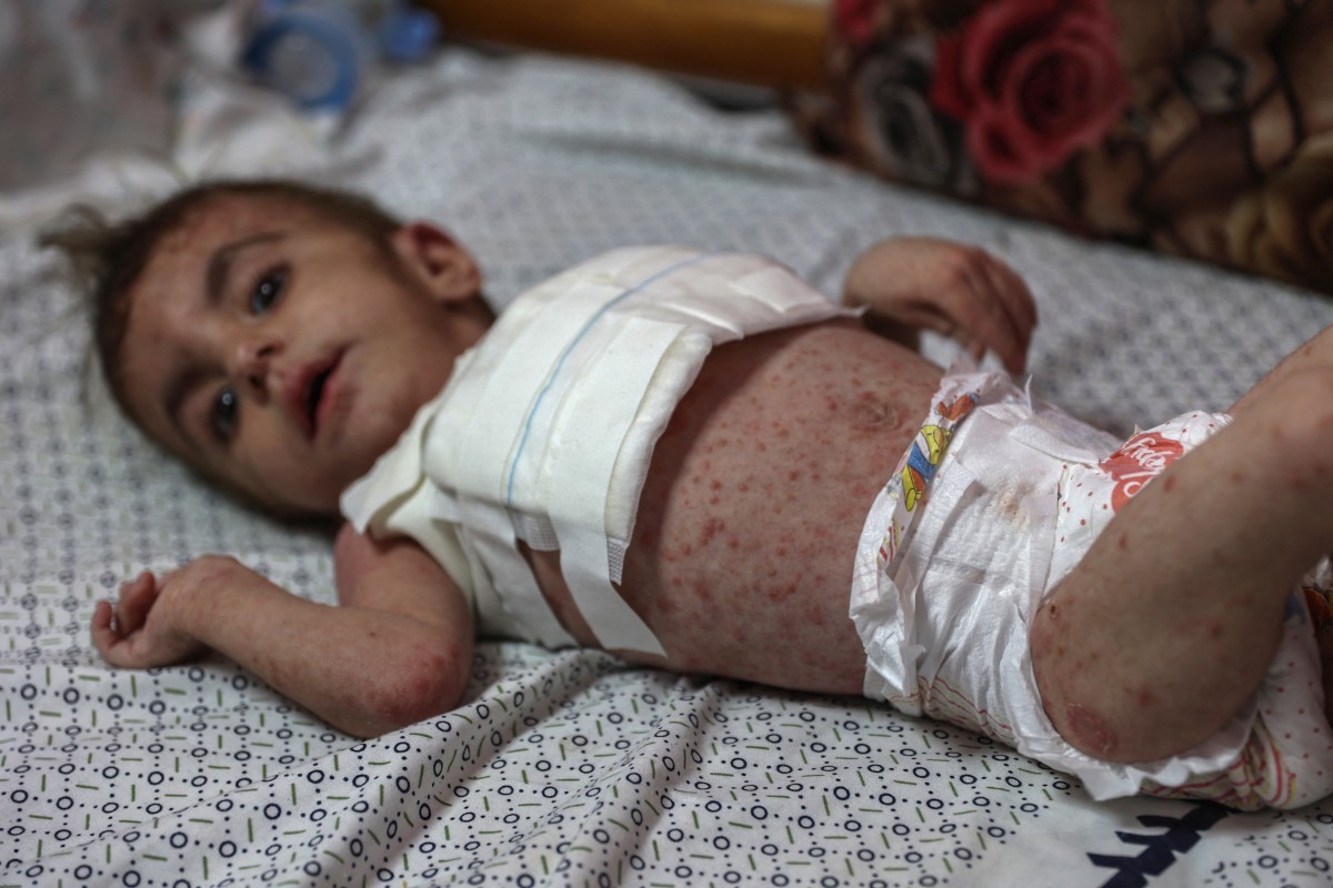 Palestinian baby girl Wateen al-Adasi who developed a skin condition due to malnutrition