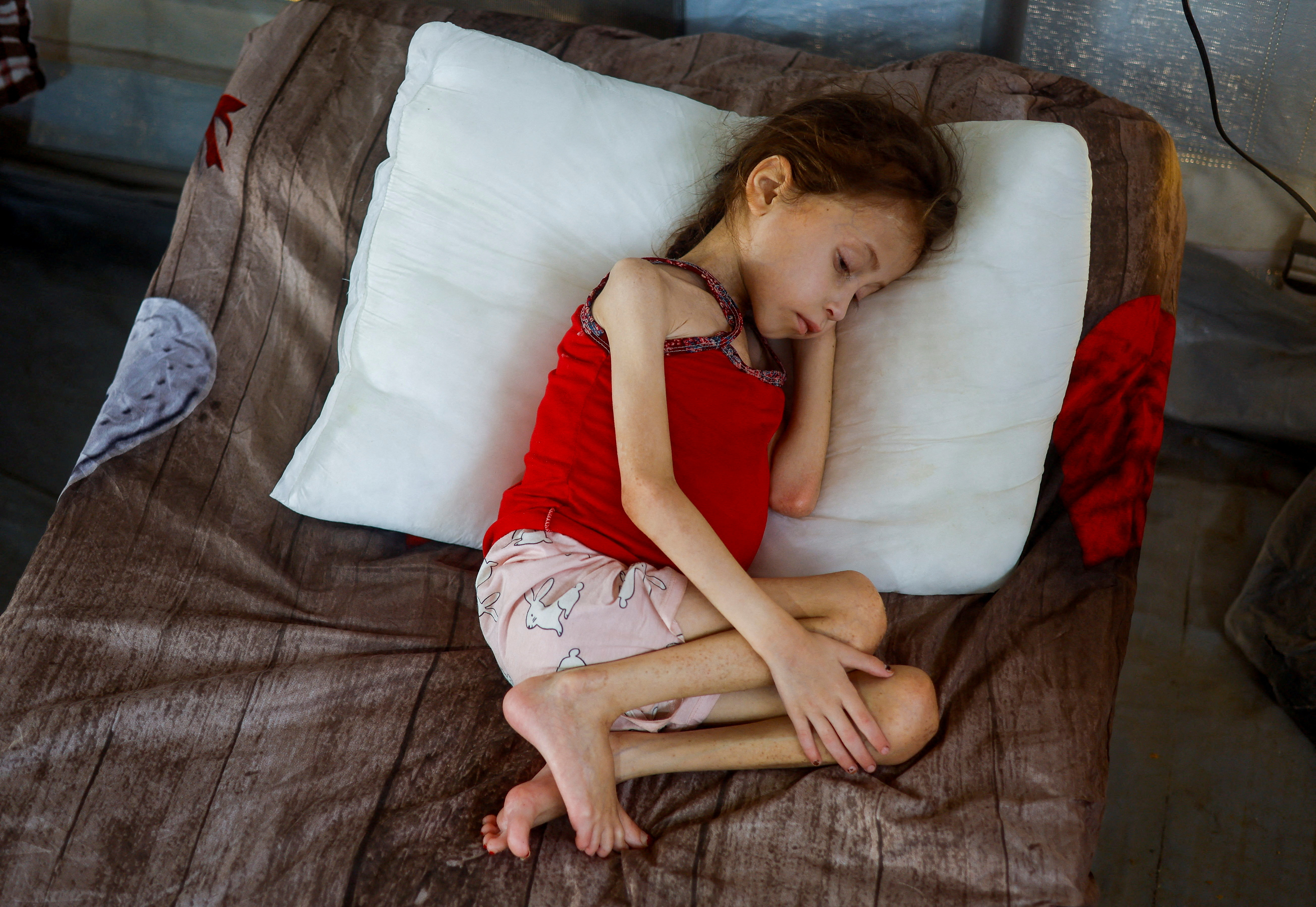 Jana Ayad, a malnourished Palestinian girl, rests on a bed as she receives treatment at the International Medical Corps field hospital, in Deir el-Balah, Gaza, June 22, 2024