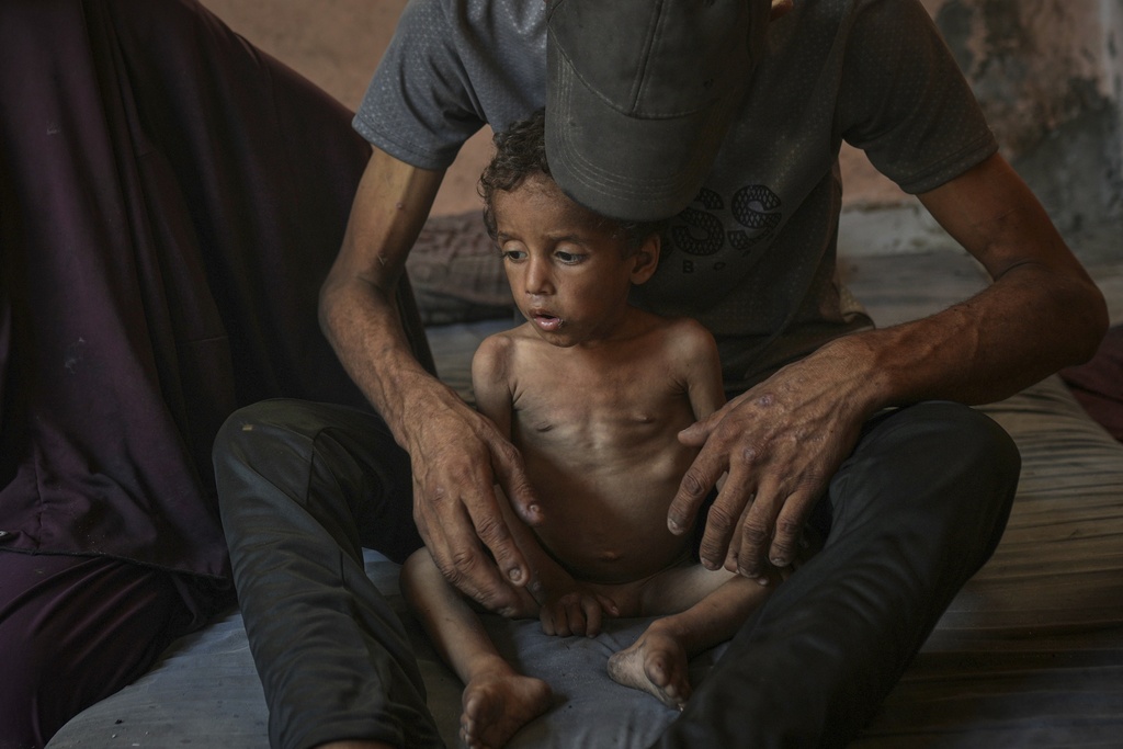 emaciated child