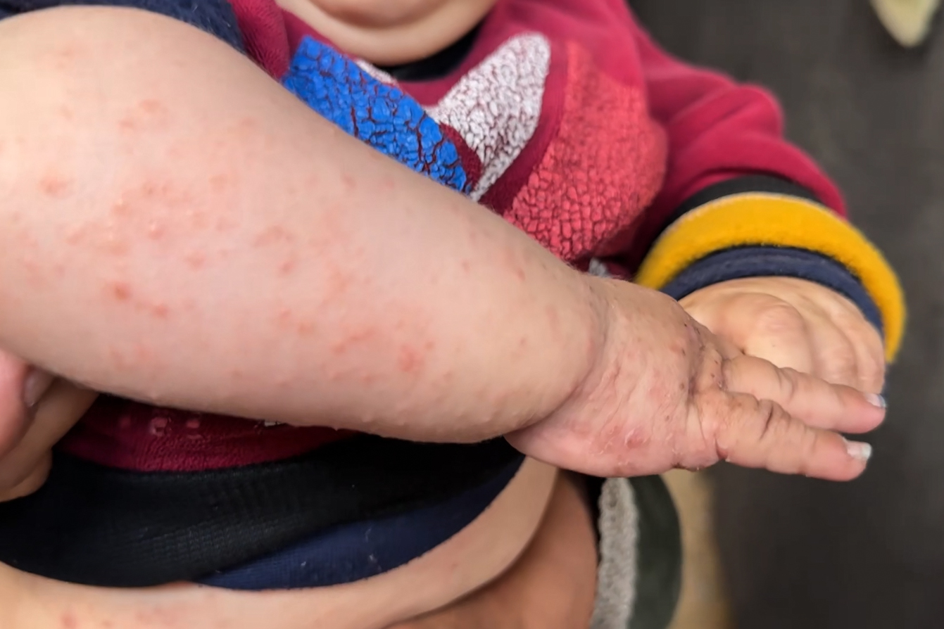 Six-month-old Fares Sobh suffers from severe skin infections and asthma caused by the unsanitary conditions at the al-Taawun camp in Gaza City, where displaced families are forced to live atop a solid waste dump. [Screengrab/Al Jazeera]