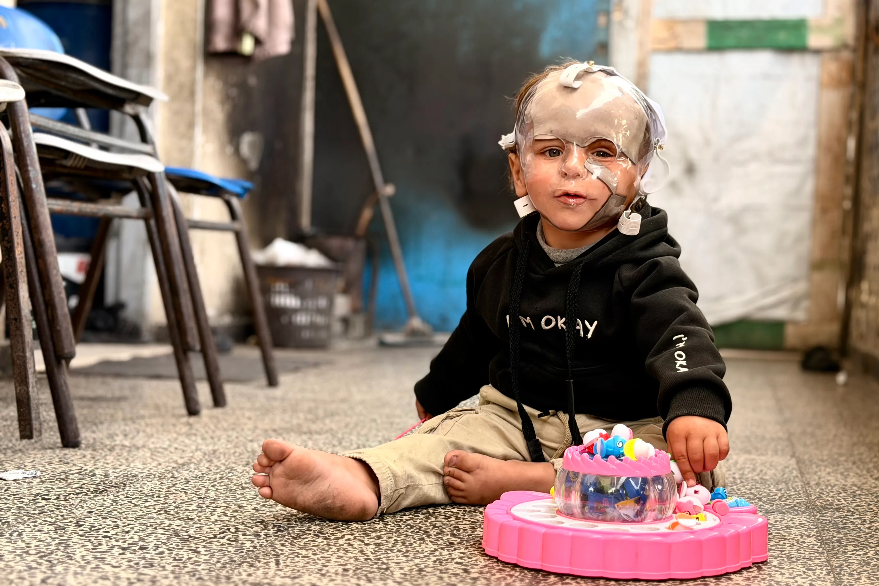 Two-year-old infant wears a facial pressure mask.