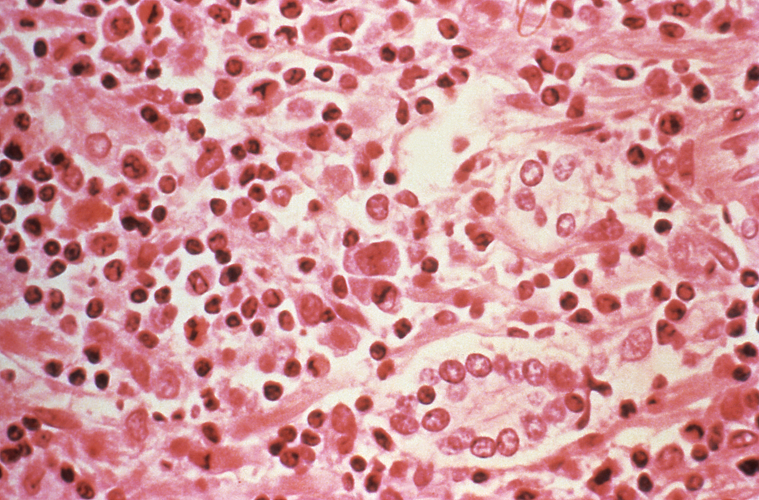 hantavirus
