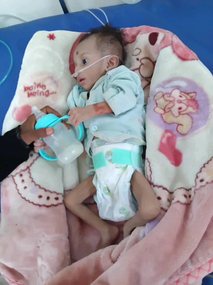 A malnourished child in Al-Dhalea Governorate, southern Yemen (Al Jazeera)