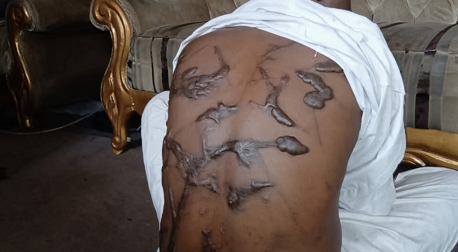 Haruna Hamza displays scars on his back from an alleged assault in Adamawa State, Nigeria